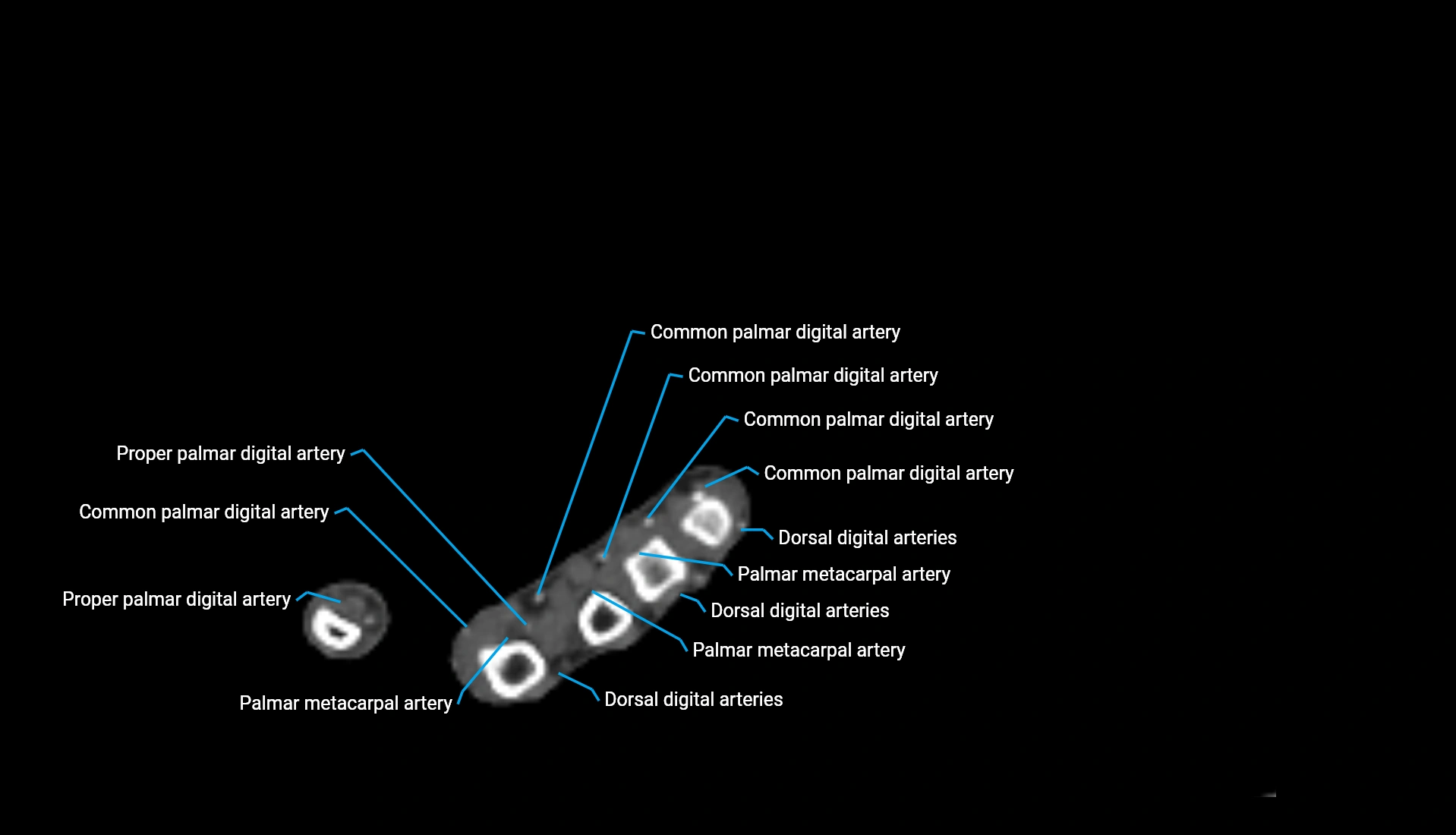 CTA upper limb axial cross sectional anatomy labelled image 49 (2).webp